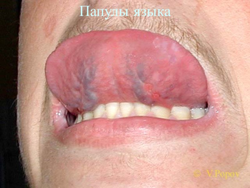 Папулы языка